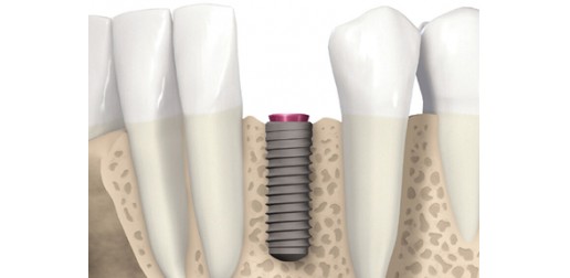Remplacement de dents manquantes - Implants dentaires