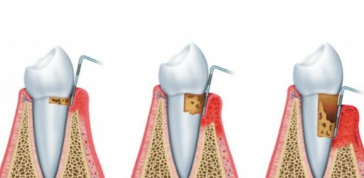 Traitements de gencives - Curetage