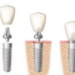 Implants dentaires