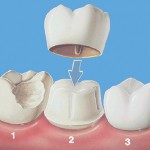 Couronnes en céramique