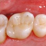 Incrustations en céramique