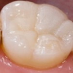 Incrustations en céramique